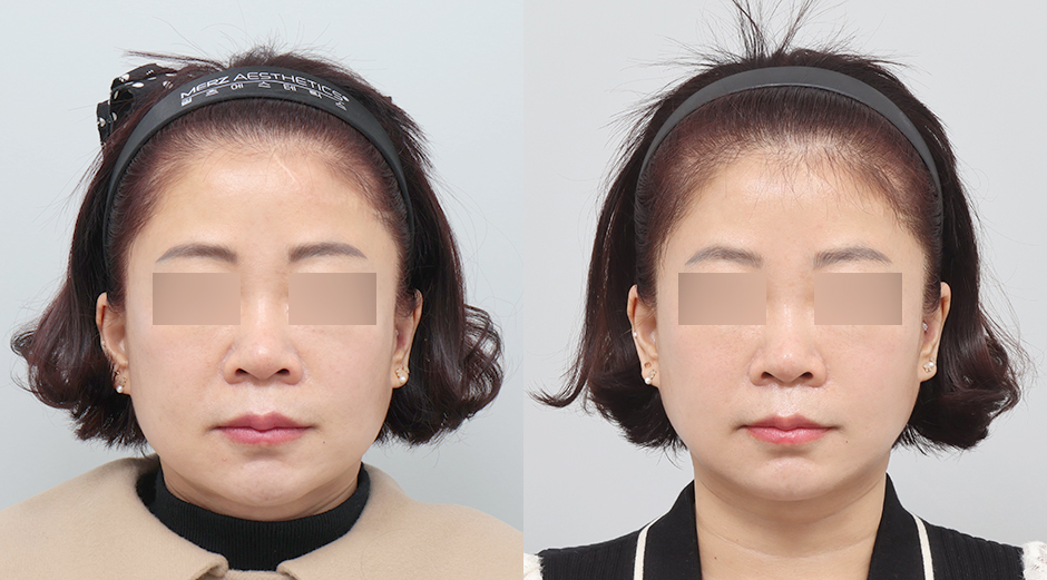 쥬베룩볼륨 전후 시술 후 1개월