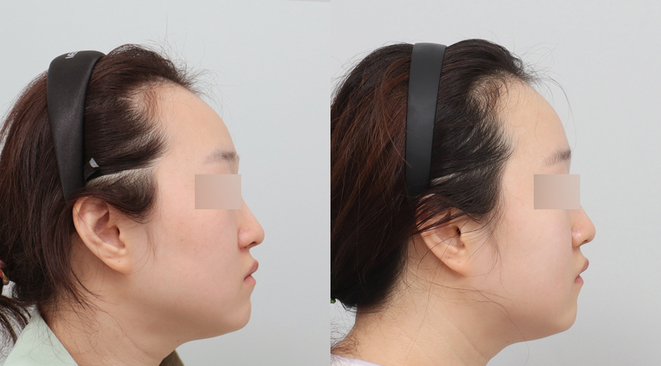 리쥬란 힐러 전후 시술 후 1개월