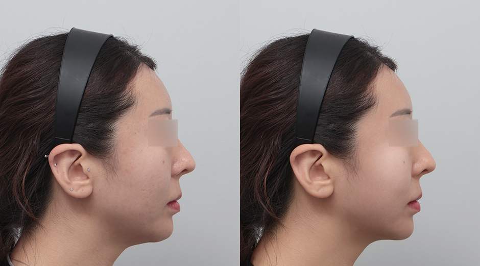 포텐자 전후, 레스노베크리스탈 전후 시술 후 1개월