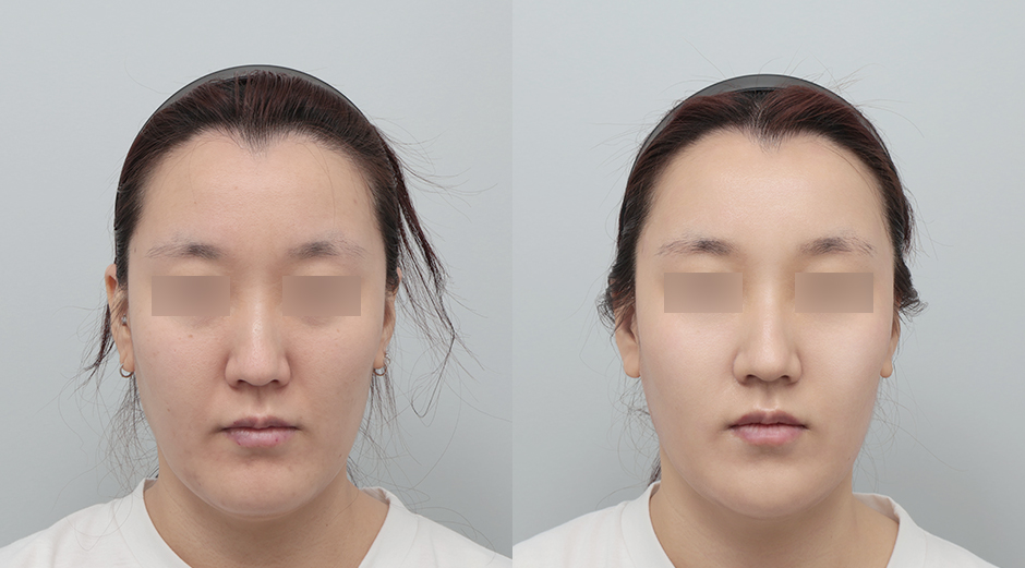 포텐자 전후, 레스노베크 전후 시술 후 1개월