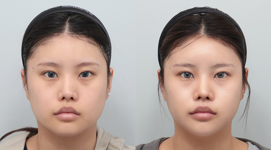 울쎄라 전후, 리쥬란 전후 시술 후 1개월