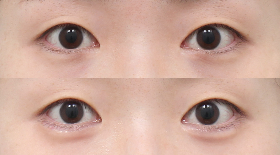 애교필러 시술 전후 정면