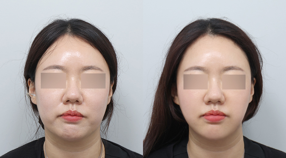 온다리프팅 (얼굴) 전후 시술 후 1개월