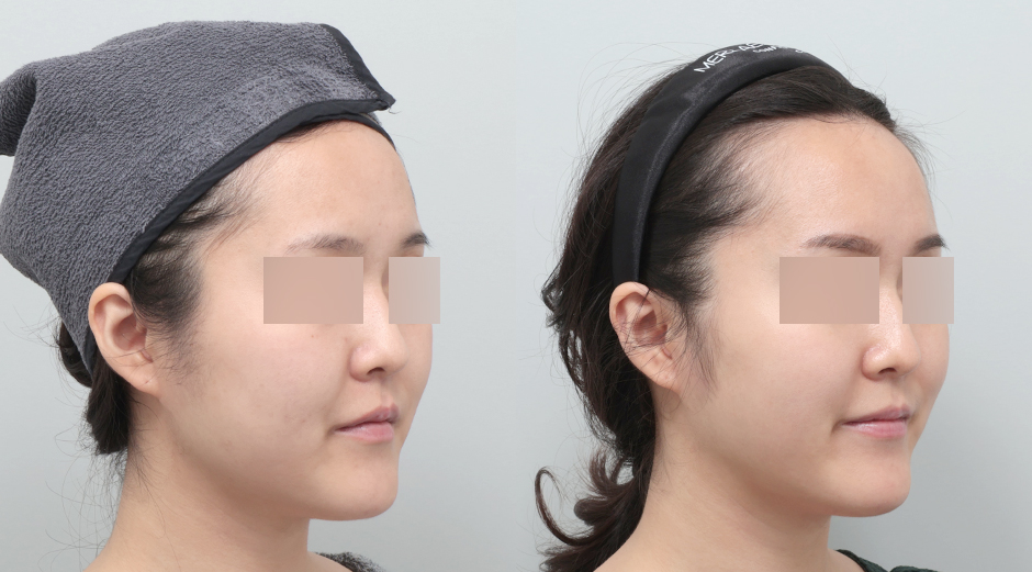 포텐자 전후, 레스노베크리스탈 전후 시술 후 1주차