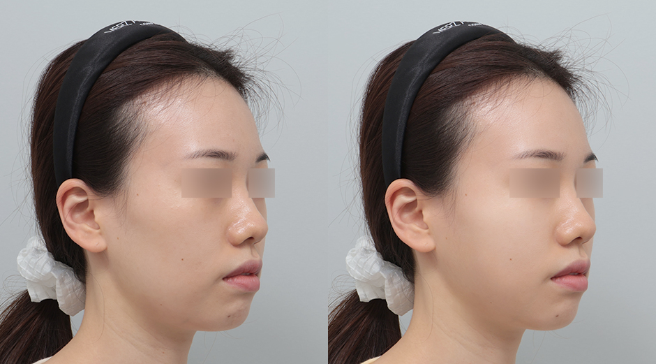 포텐자 전후, 레스노베크리스탈 전후 시술 후 1개월