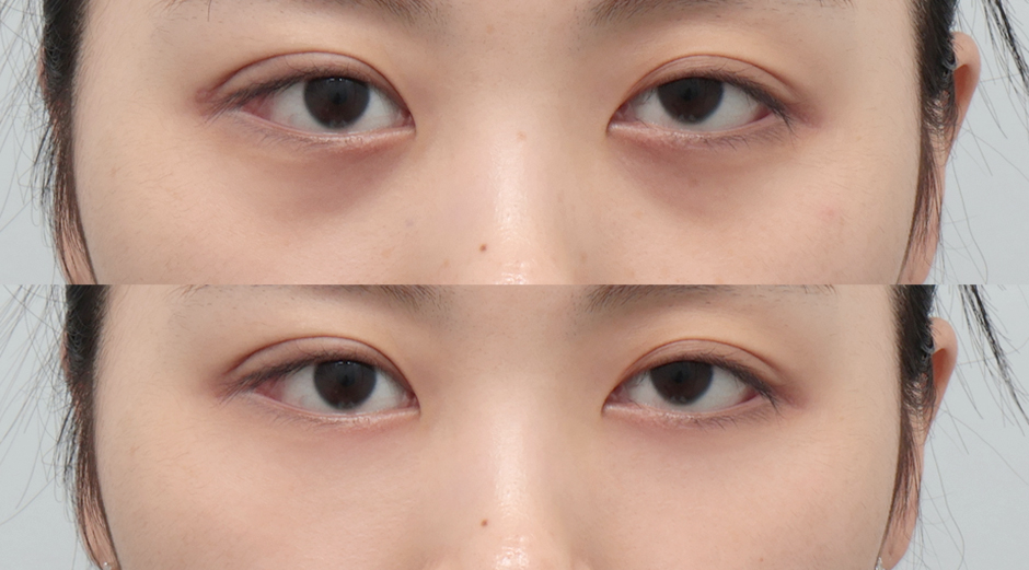 에이빛아이 전후 시술 후 1개월