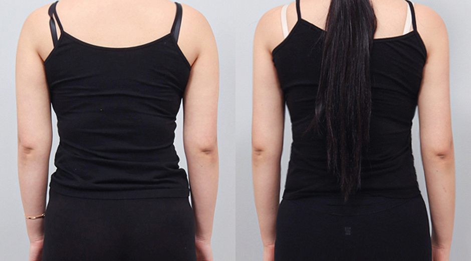 바디 에이빼주사 시술 전후