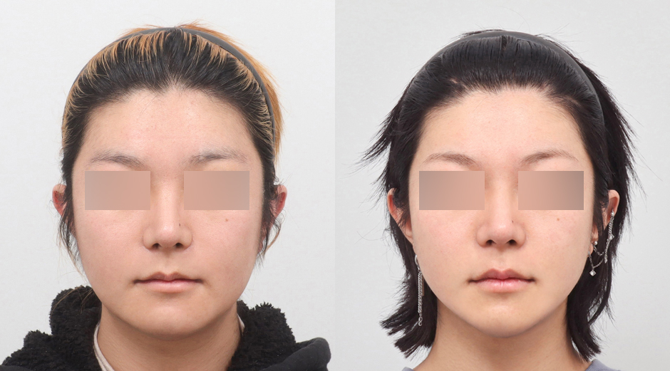 울쎄라 시술 전후