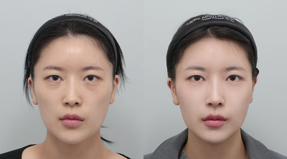 쥬베룩볼륨 시술 전후