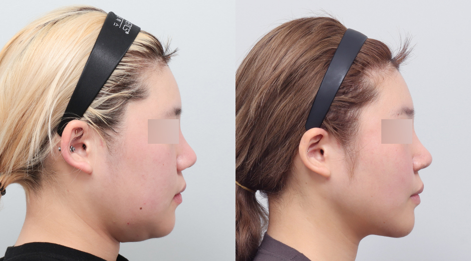 얼굴 에이빼주사 전후 시술 후 1개월