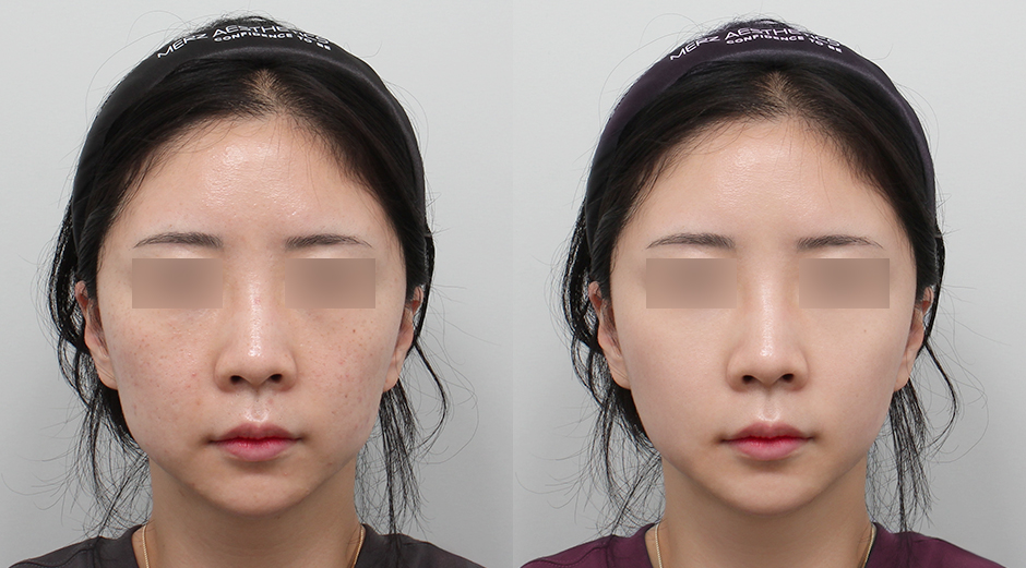 포텐자 전후, 레스노베크리스탈 전후 시술 후 1개월