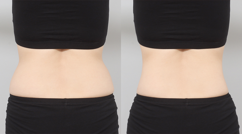 바디 에이빼 전후 시술 후 1개월