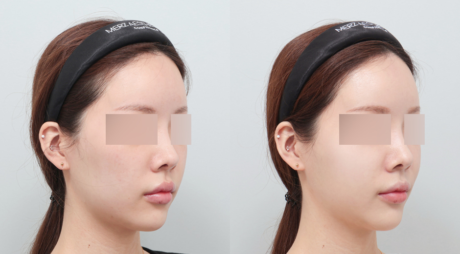 리쥬란 힐러 전후 시술 후 1개월