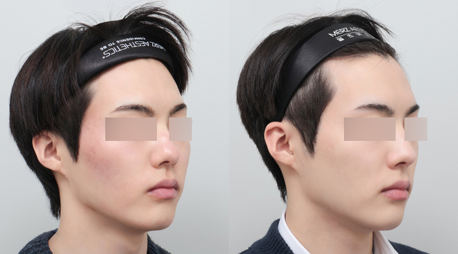 포텐자 전후, 쥬베룩 전후 시술 후 1개월