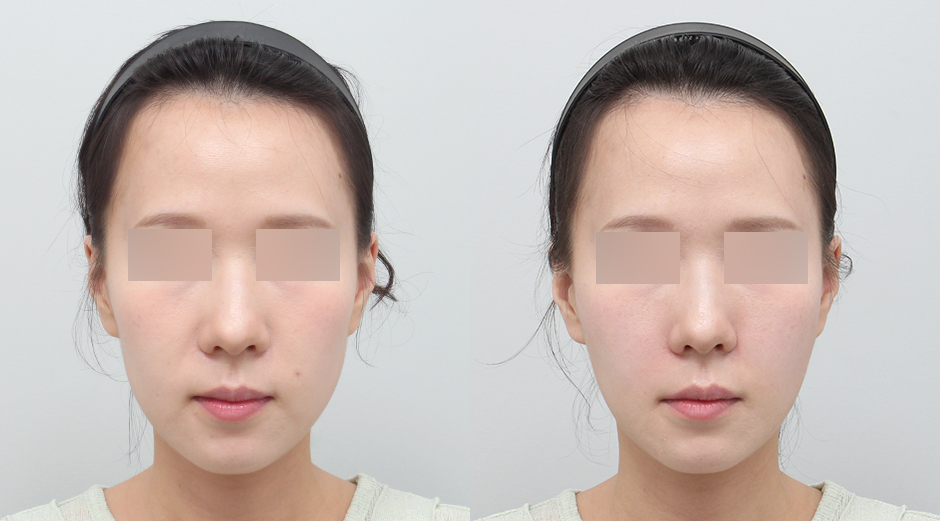 쥬베룩볼륨 시술 전후