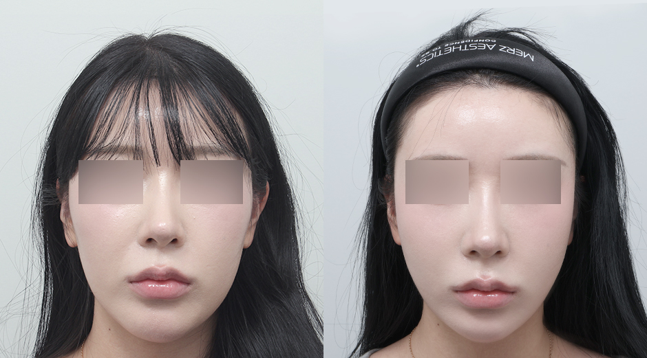 쥬베룩볼륨 (팔자) 전후 시술 후 1개월