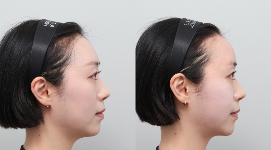 이마필러 시술 전후 측면