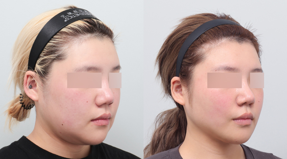얼굴 에이빼주사 전후 시술 후 1개월