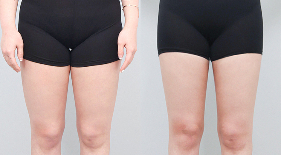 에이빼주사 시술 전후