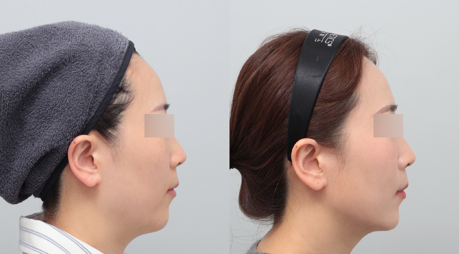 울쎄라 전후 시술 후 1개월