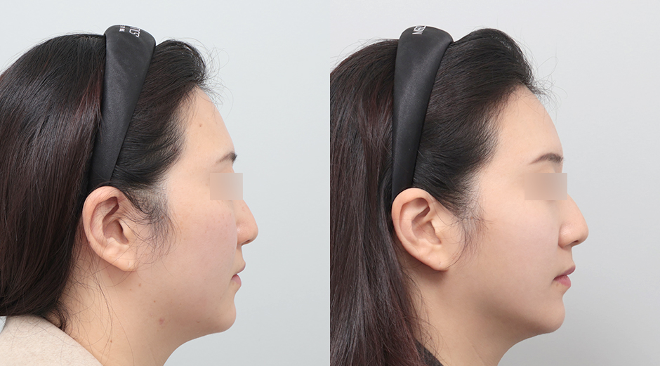 줄기세포 전후 시술 후 1개월