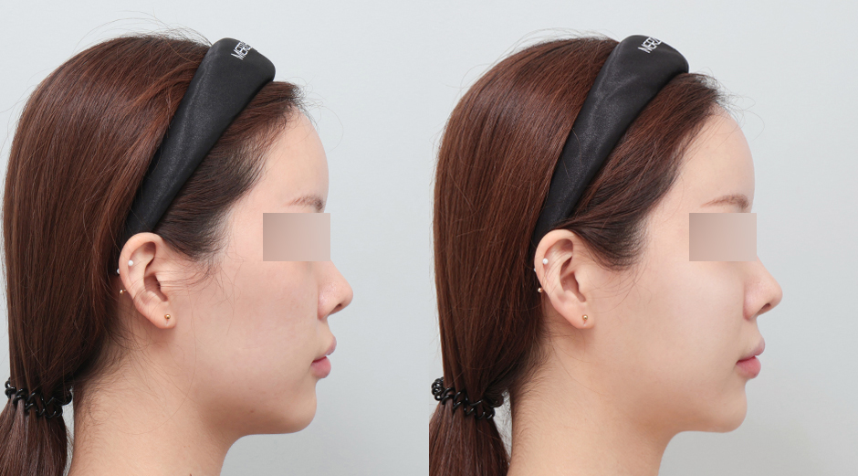 리쥬란 힐러 전후 시술 후 1개월