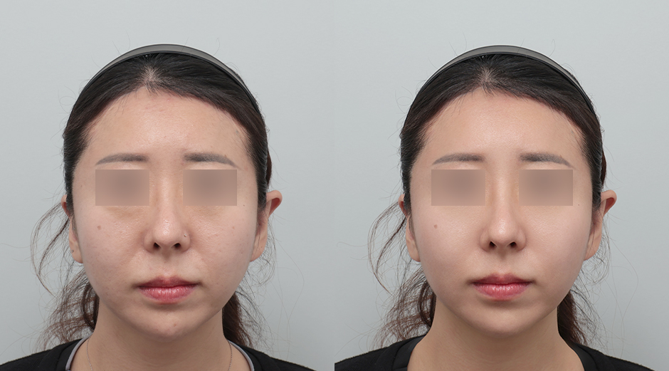 포텐자 전후, 레스노베크리스탈 전후 시술 후 1개월