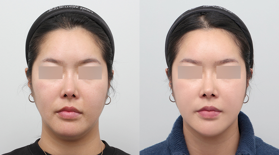 리투오 전후, 쥬베룩볼륨 전후 시술 후 1개월