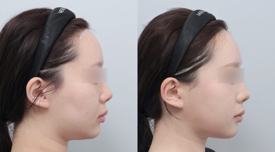 울쎄라 전후 시술 후 1개월