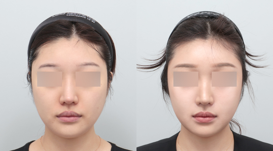 울쎄라 시술 전후