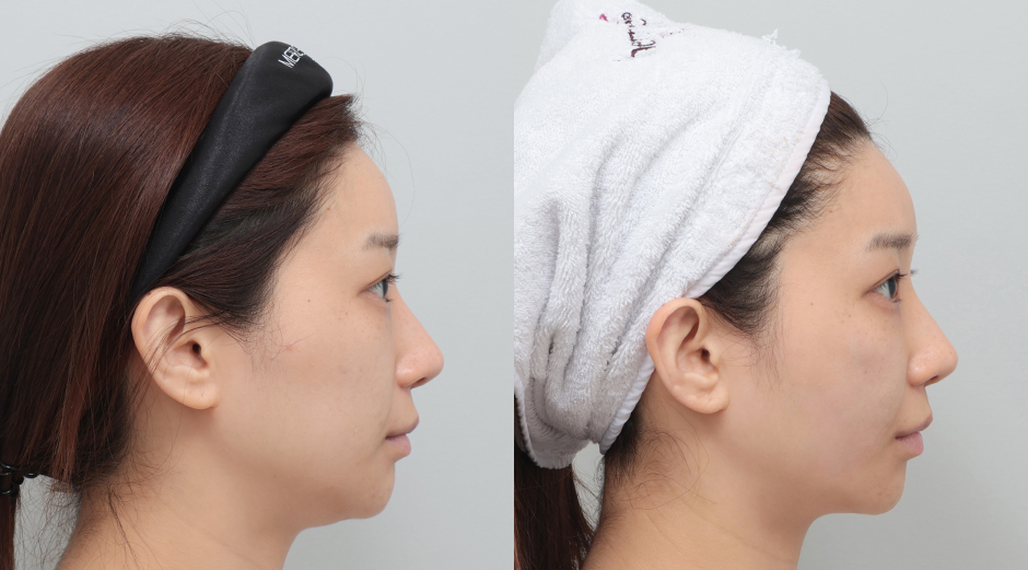 울쎄라 전후, 쥬베룩 전후 시술 후 1개월