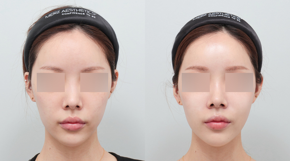 리쥬란 힐러 시술 전후