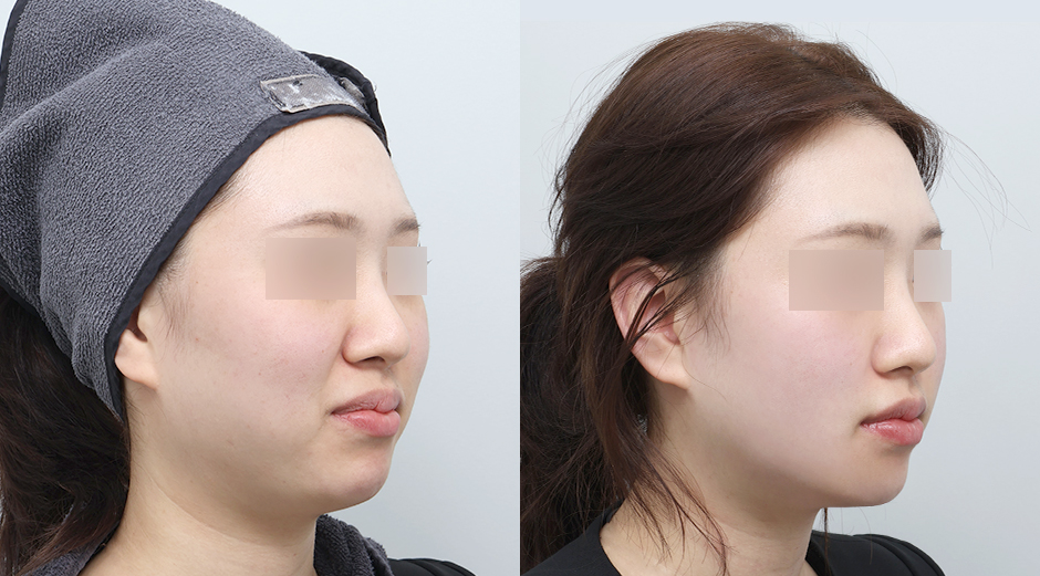 온다리프팅 (얼굴) 전후 시술 후 1개월