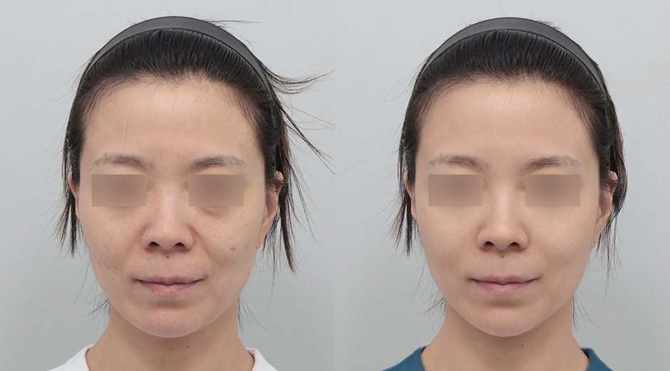 포텐자 전후, 레스노베크리스탈 전후 시술 후 1개월