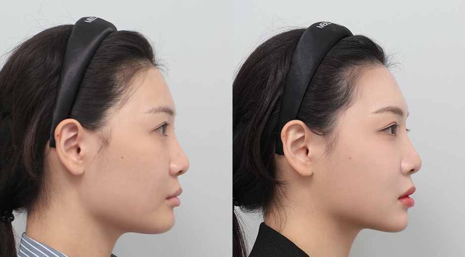 울쎄라 전후, 얼굴에이빼 전후 시술 후 1개월