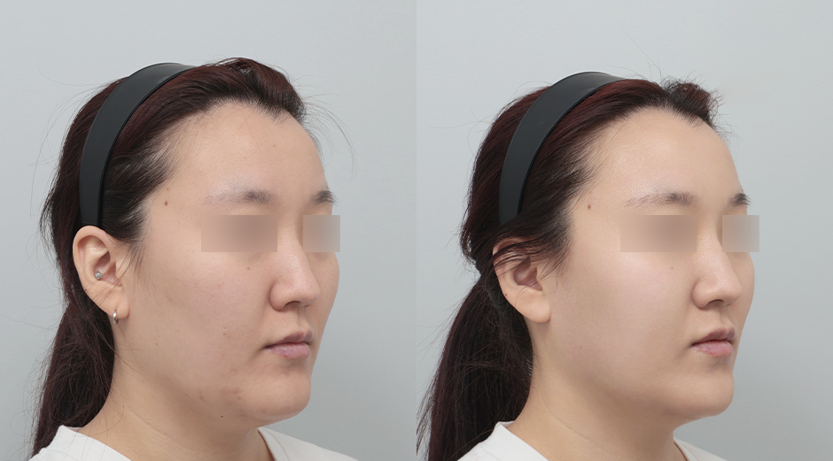 포텐자 전후, 레스노베크 전후 시술 후 1개월