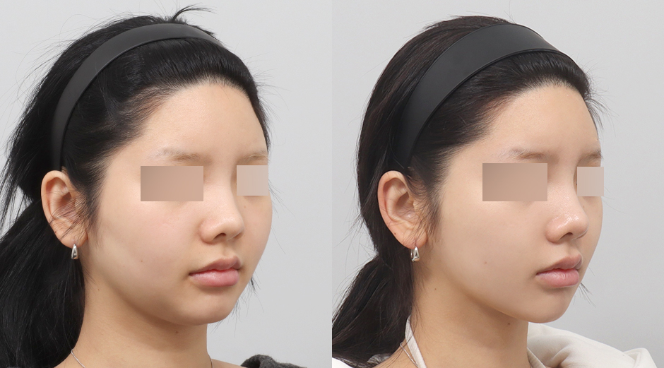 울쎄라 전후, 얼굴 에이빼 전후 시술 후 1개월
