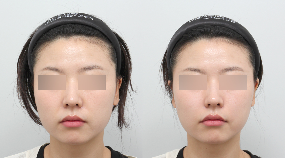 쥬베룩볼륨 시술 전후