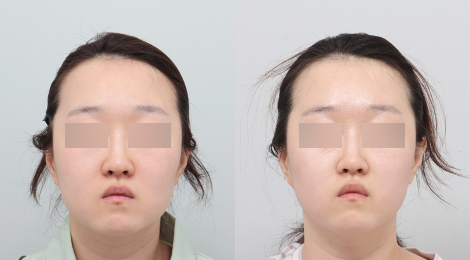 리쥬란 힐러 시술 전후