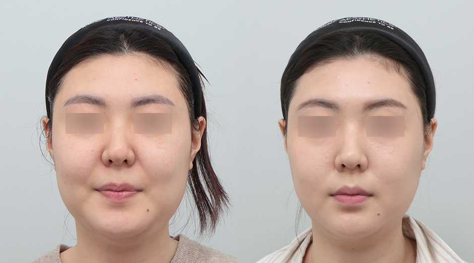 실리프팅 전후 시술 후 1개월