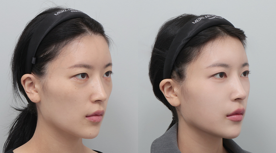 쥬베룩볼륨 전후 시술 후 1개월