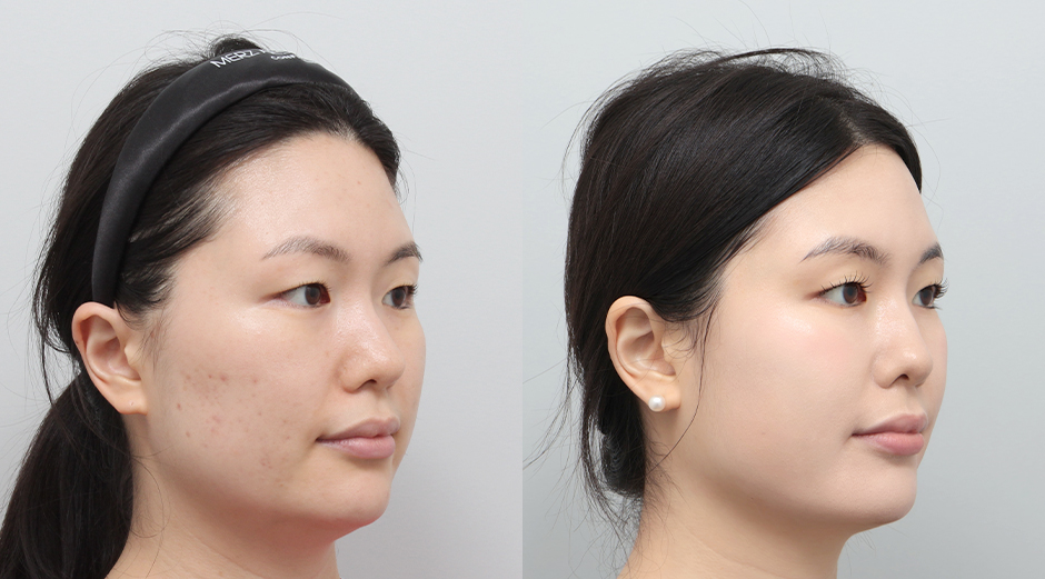 울쎄라 전후, 얼굴에이빼 전후 시술 후 1개월