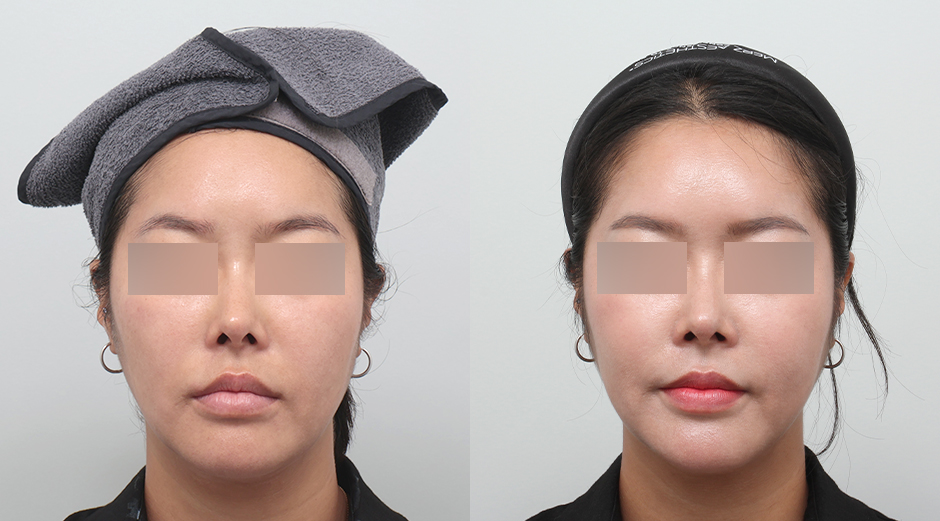 울쎄라 시술 전후, 써마지 시술 전후, 얼굴 에이빼주사 시술 전후, 에이빛풀페이스 시술 전후