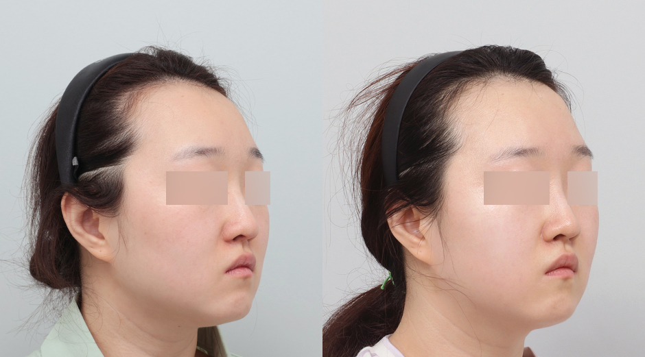 리쥬란 힐러 전후 시술 후 1개월