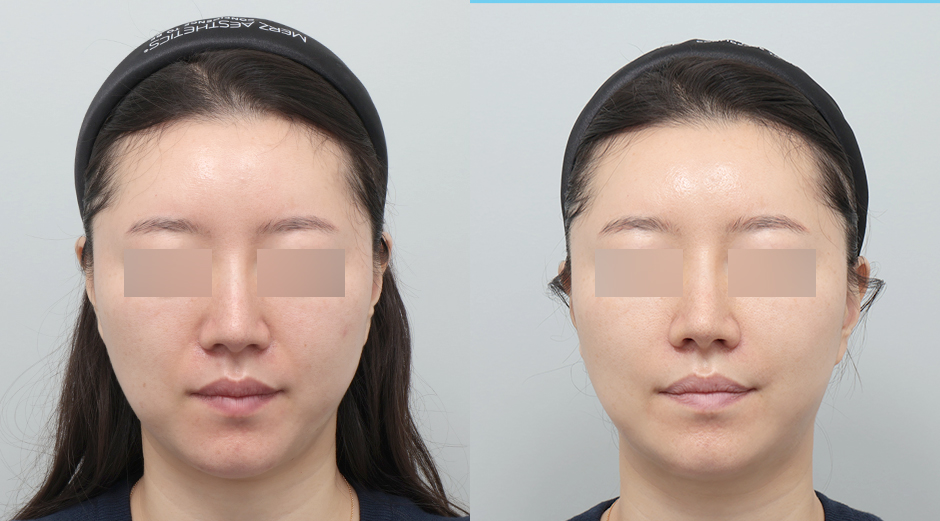 쥬베룩볼륨 시술 전후 정면