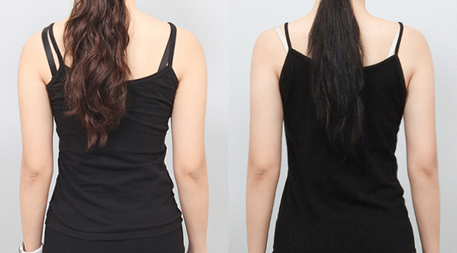 바디 에이빼주사 시술 전후