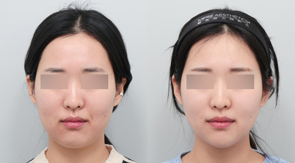 옆볼 쥬베룩 시술 전후, 울쎄라 시술 전후