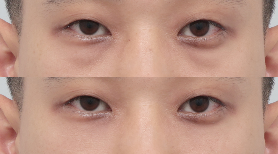 에이빛아이 시술 전후