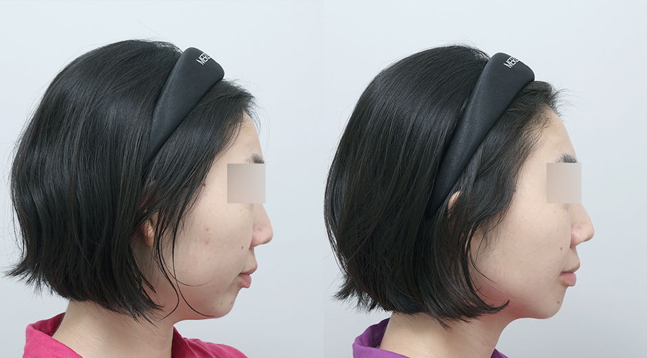 온다리프팅 (얼굴) 전후 시술 후 1개월