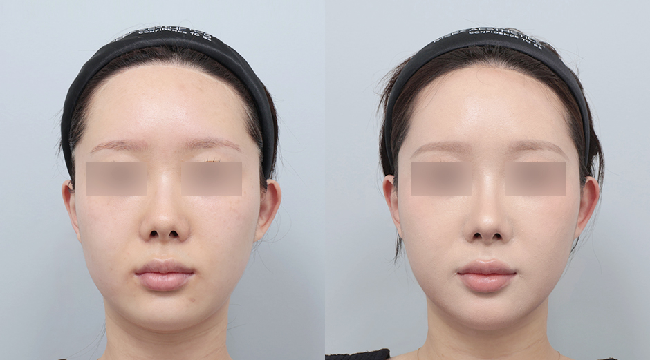 울쎄라 시술 전후